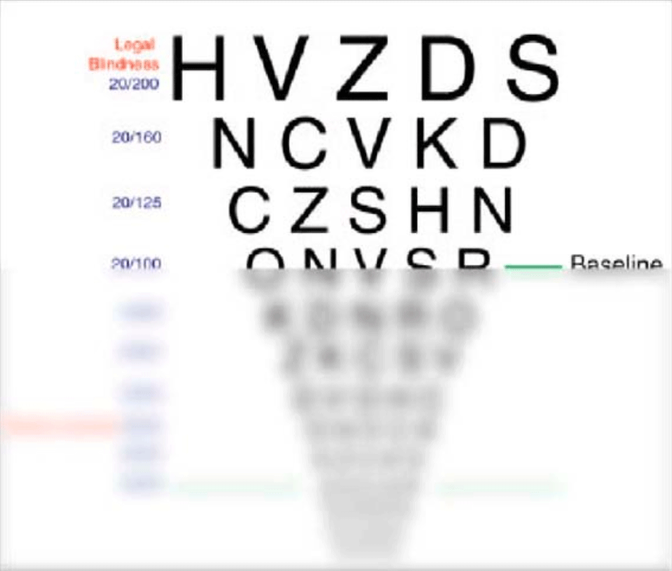ETDRSチャートでの視力変化