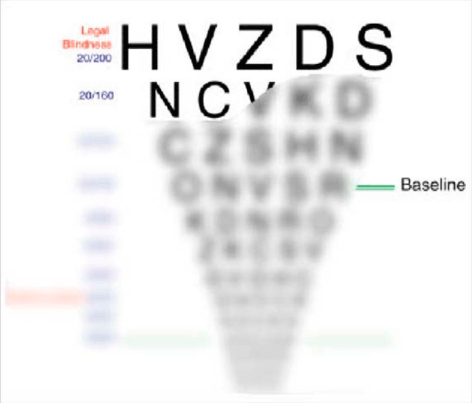 ETDRSチャートでの視力変化