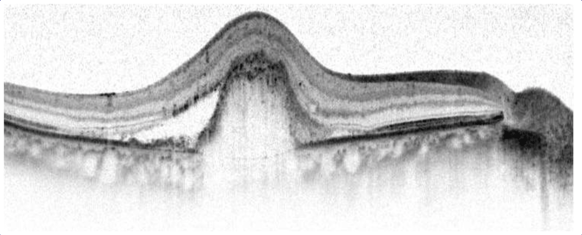 滲出型加齢黄斑変性症