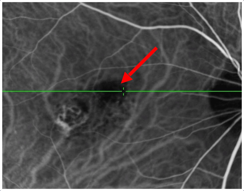 インドシアニングリーン蛍光眼底造影