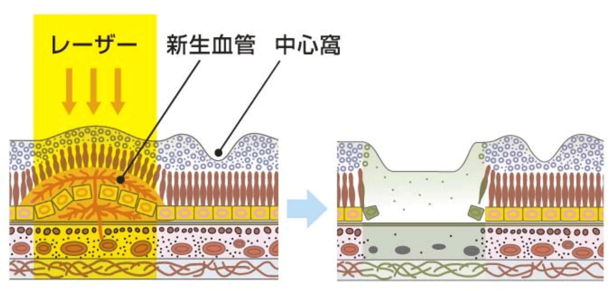 レーザー光凝固