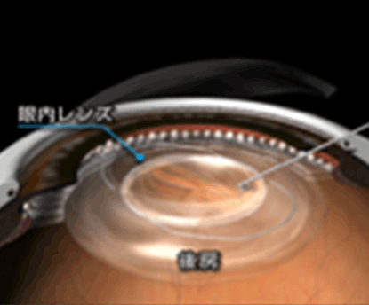 眼内レンズを眼内にインサート