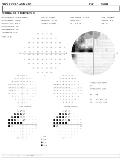 HF30 右眼 緑内障