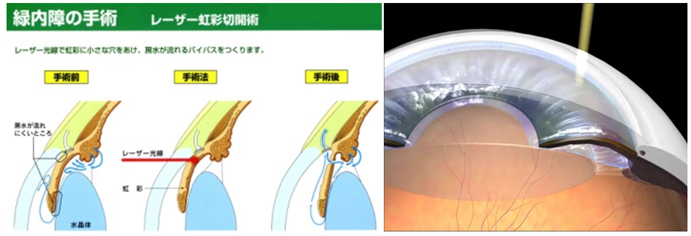 レーザー虹彩切開術