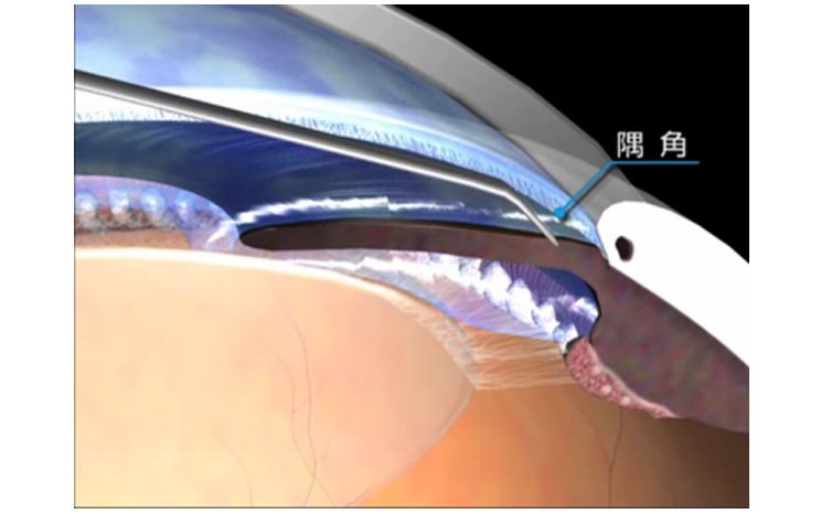 隅角癒着解離術