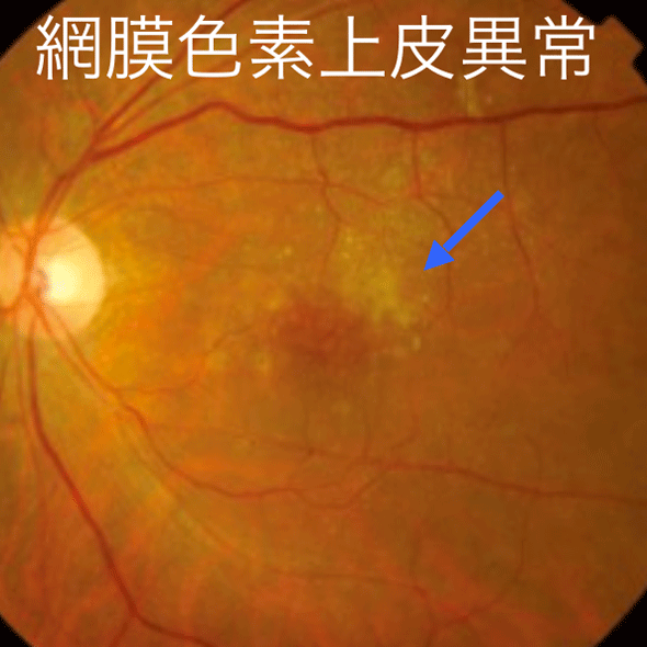 滲出型加齢黄斑変性症