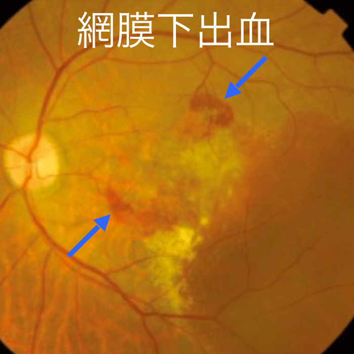 滲出型加齢黄斑変性症
