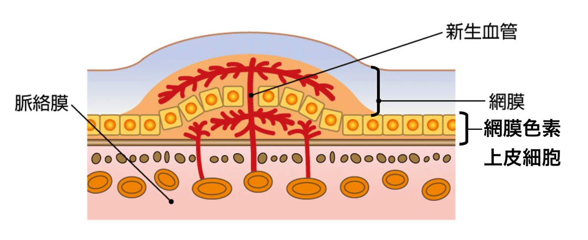 滲出型加齢黄斑変性症の黄斑
