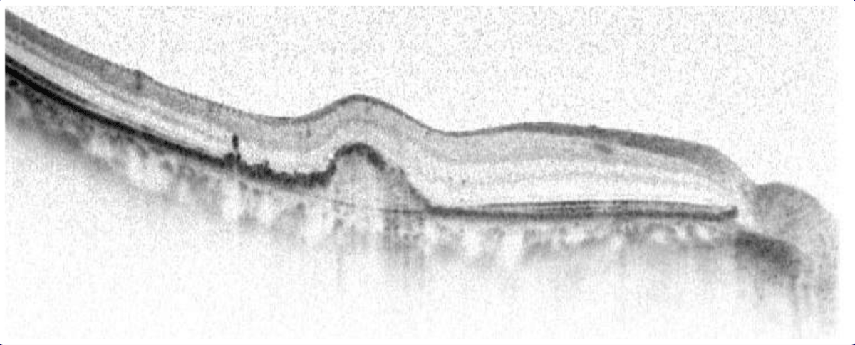 滲出型加齢黄斑変性症