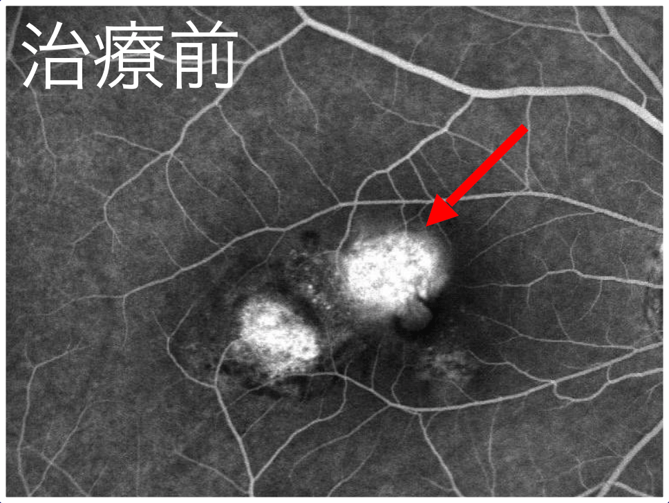フルオレセイン蛍光眼底造影 治療前