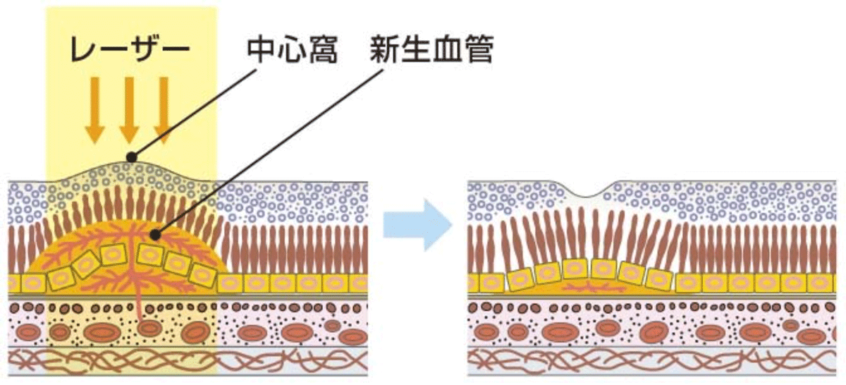 経瞳孔温熱療法（TTT）