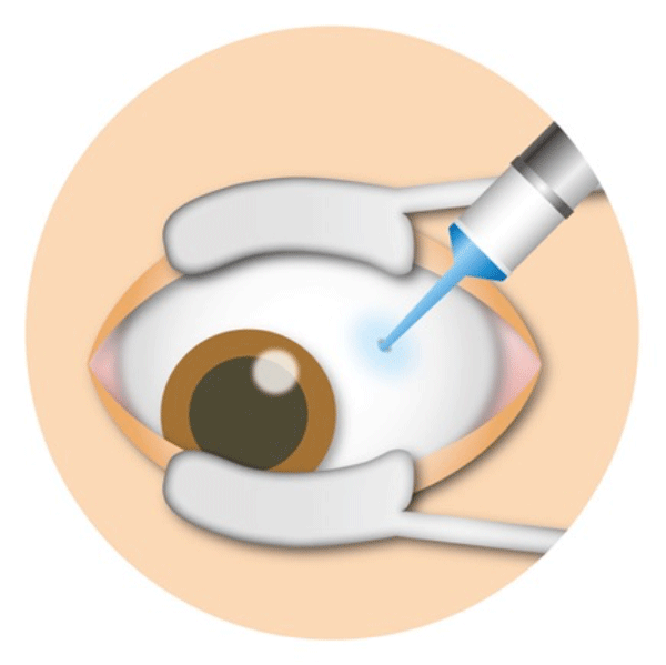 ルセンティス治療の手順②