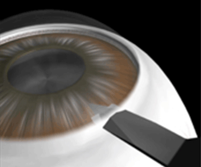 強角膜耳側より、2.0-2.4mm切開