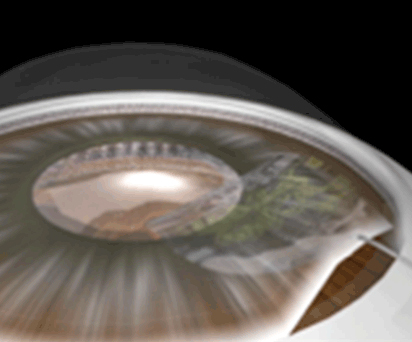 前嚢切開は前嚢鑷子を用いて、4-5mm経で正円に行う