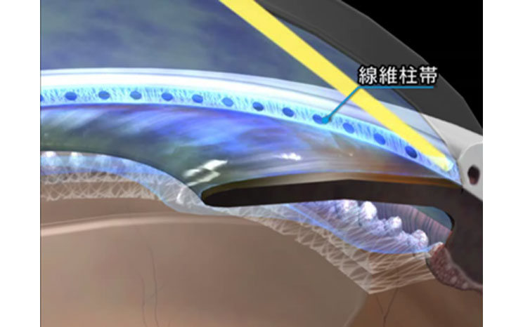 レーザー線維柱帯形成術