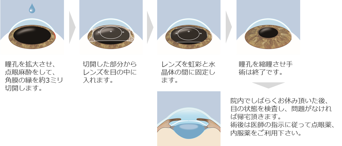眼内コンタクトレンズ治療手術の流れ