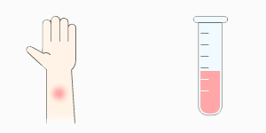 スギ花粉アレルギー検査