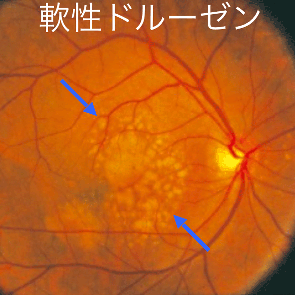 加齢黄斑変性症治療 | 疾患別 | 清瀬えのき眼科｜白内障日帰り手術など眼科手術