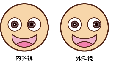 斜視