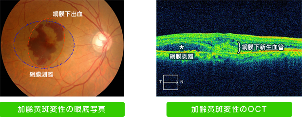 加齢黄斑変性
