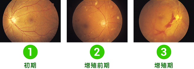 糖尿病網膜症