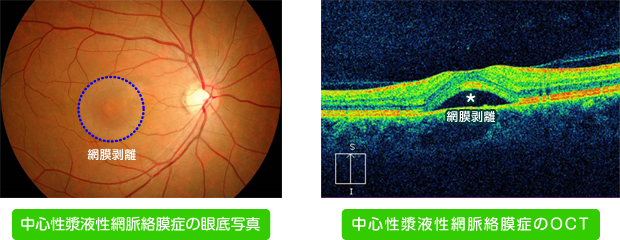 中心性漿液性網脈絡膜症
