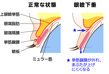 眼瞼下垂