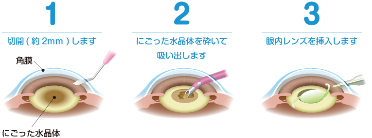 日帰り白内障手術