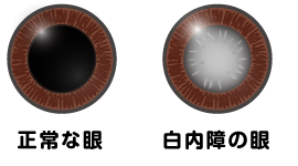 目の病気 白内障