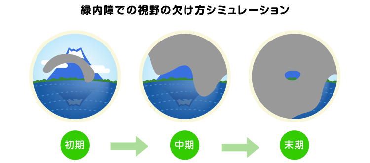 目の病気 緑内障