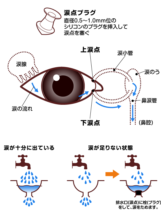 涙点プラグ 挿絵