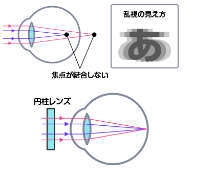 乱視