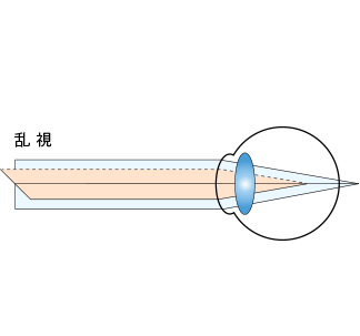 乱視