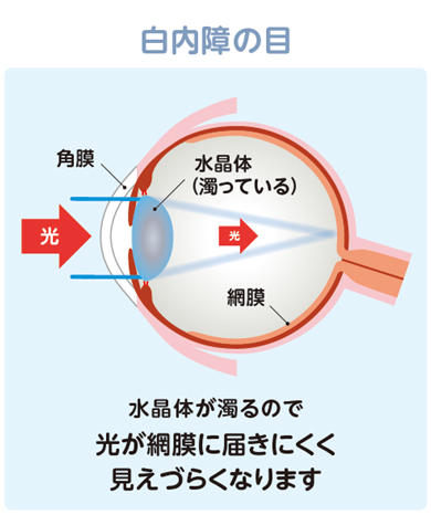 白内障の目